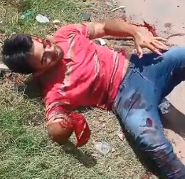 Man Lost Palm In Machete Attack