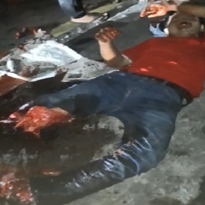 Welcome To The Amputee Club