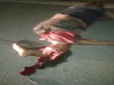 shattered legs after accident