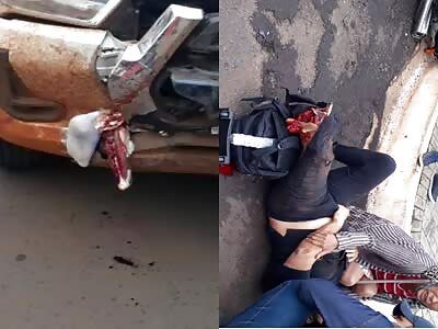 OUCH: Dude Loses Foot in Accident 