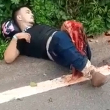 OUCH: Massive Leg Injury Will End up Amputated....