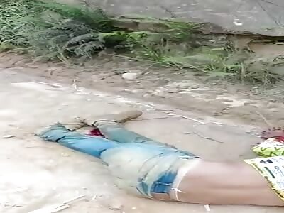 man with shattered leg after accident 