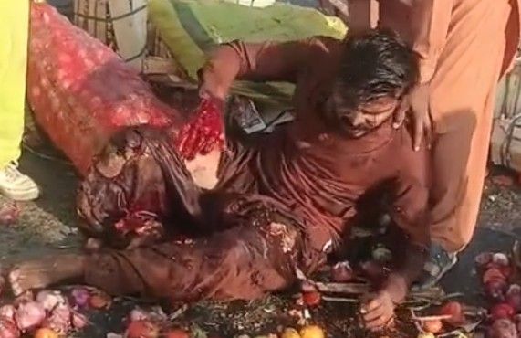 Accident leaves man with one leg