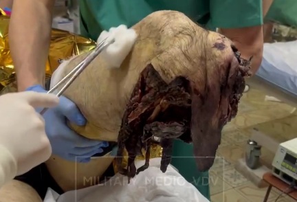 Wounded Russian soldier hospitalized after stepping on a landmine 