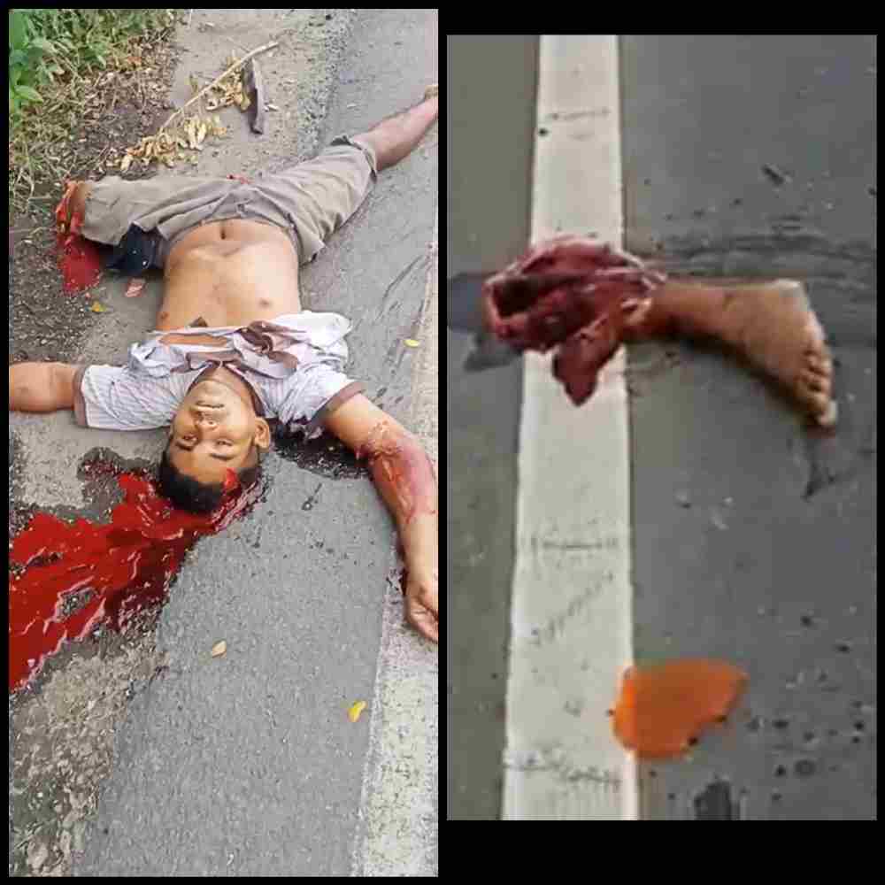 Accident Tears A Man's Foot Off 