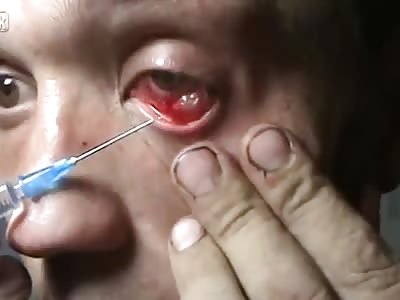 Takes Apart His Eye