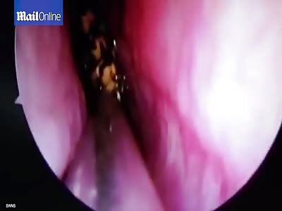 Disgusting moment cockroach is pulled from inside woman's skull