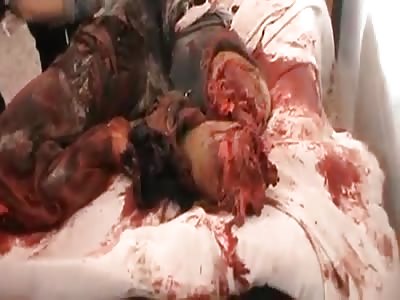 Man just stepped into a mine and she detonated