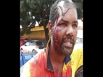 Man already operated on the face and with another blow of machete