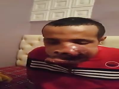 Man with horrible disease in your face  ( SKIP 1:00)