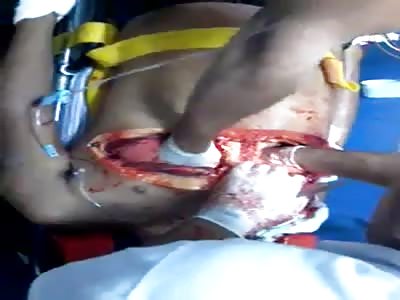 Open chest still alive