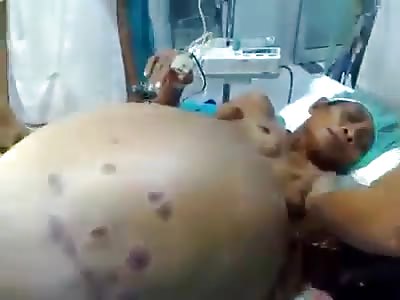 Giant hernia in the belly Giant hernia in the belly withdrawn from a woman