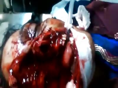 Accident serious injury face! (Woman Still Alive at ER)