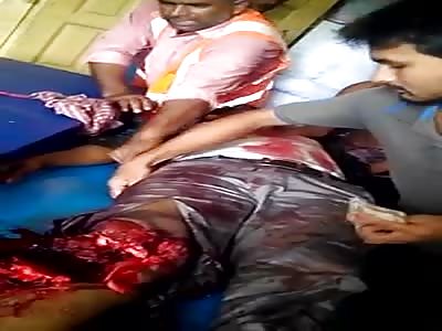 Leg destroyed on the Accident 