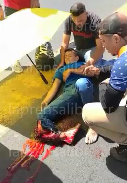 accident man loses his leg