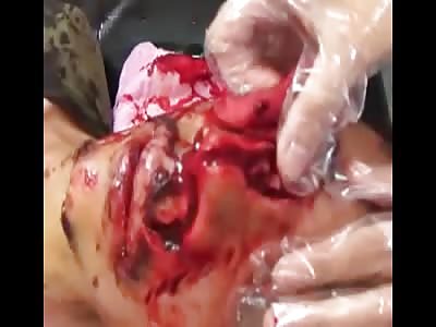 man with face injuried 