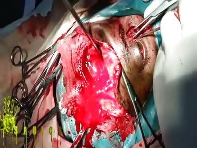 extraction of a piece of glass from the face