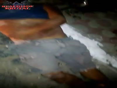 Man exposes a beautiful fracture acquired in an accident