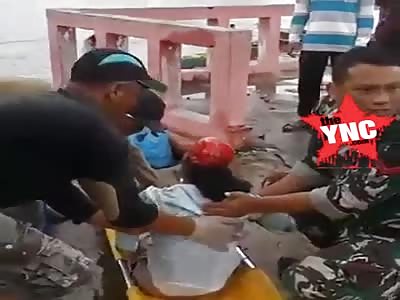 WHOA! Girl Was Horribly Scalped after Accident 