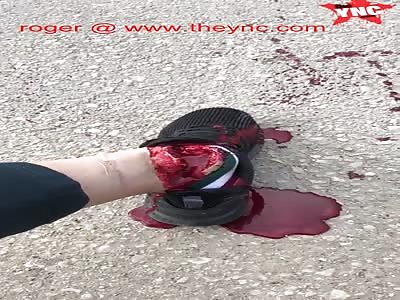 man with a open leg wound in Israel 