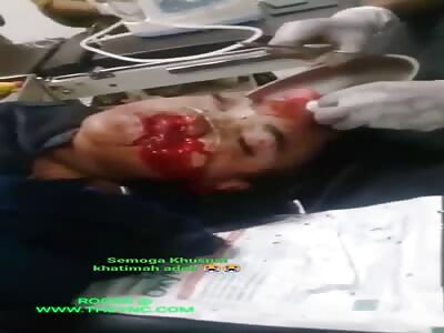 Woman with a bloody nose after a kempo karate accident in Sumbawa