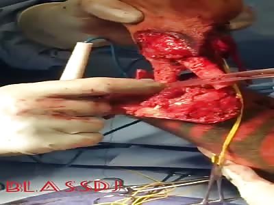 Amputated his hand after an accident