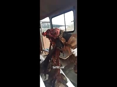 Butchery : Resulting from Treading an Antipersonnel Mine