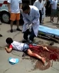 Poor Kid with Nasty Leg Break has her Foot Flopping around 