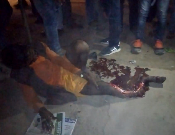 Horrific Leg Injury leaves Man in Shock