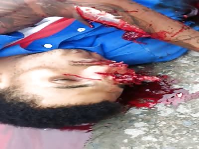 Up Close Footage of a Man with Destroyed Face from a Shotgun Blast