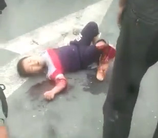  Poor Kid with Nasty Leg Break has his Foot Flopping around 