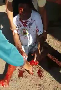 Man with Nasty Leg Break wants Help from Someone