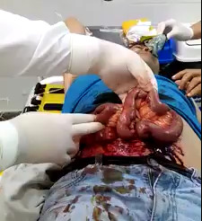 Man with his Guts Hanging out After gets Stabbed 