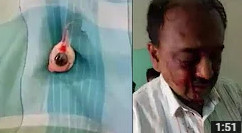 Father's Eyes Gouged Out By Son Over Property Dispute