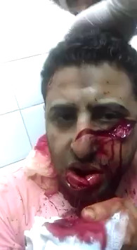 Devastating Machete Wound to Face