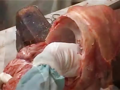 Autopsy and dissection of brain and spinal cord, for Pathology Postgraduate students.