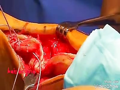 Broken Achiller Tendon Repair Surgery