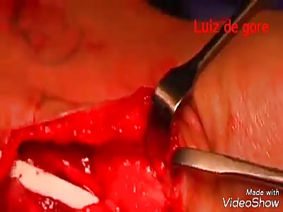 Tendon Injury Repair Surgery