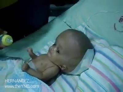 Feeding girl with hydroencephaly