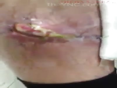 Infection in man's leg