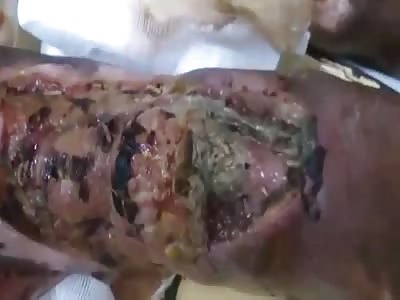Larvae on diabetic foot