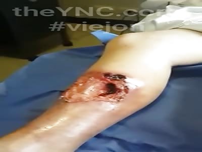 Wound with leg maggots girl