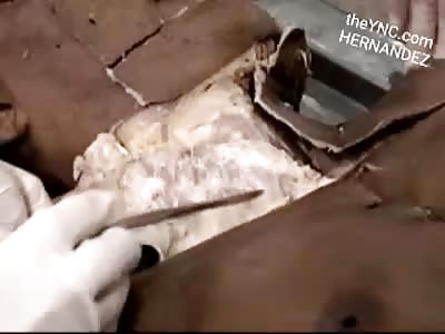 Superficial dissection