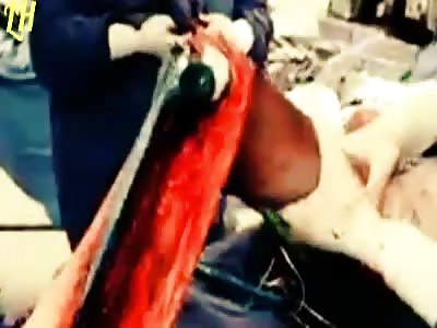 Placement of titaniun plate in femur