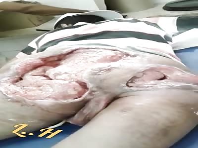 Flesh Eating Bacteria Eats Mans Buttocks.