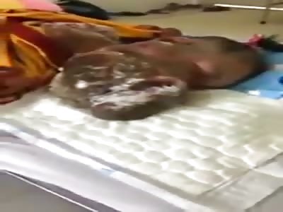 Young girls face covered in horrible tumors