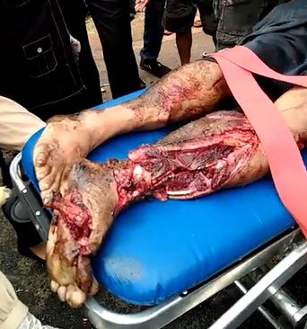 Nice View of Leg Torn Wide Open