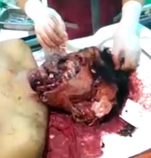 Mans Face Completely Destroyed From Accident