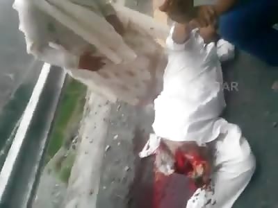 Leg Got Completely Ripped off in Accident