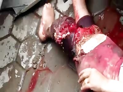 Woman Agonizing With Torn Up Leg in Budhanilkantha 